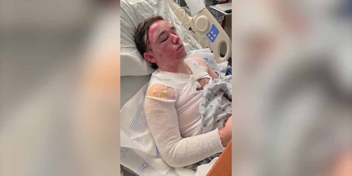McDonald's Employee Hospitalized with Severe Burns After Alleged Co-worker Attack; Suspect Arrested