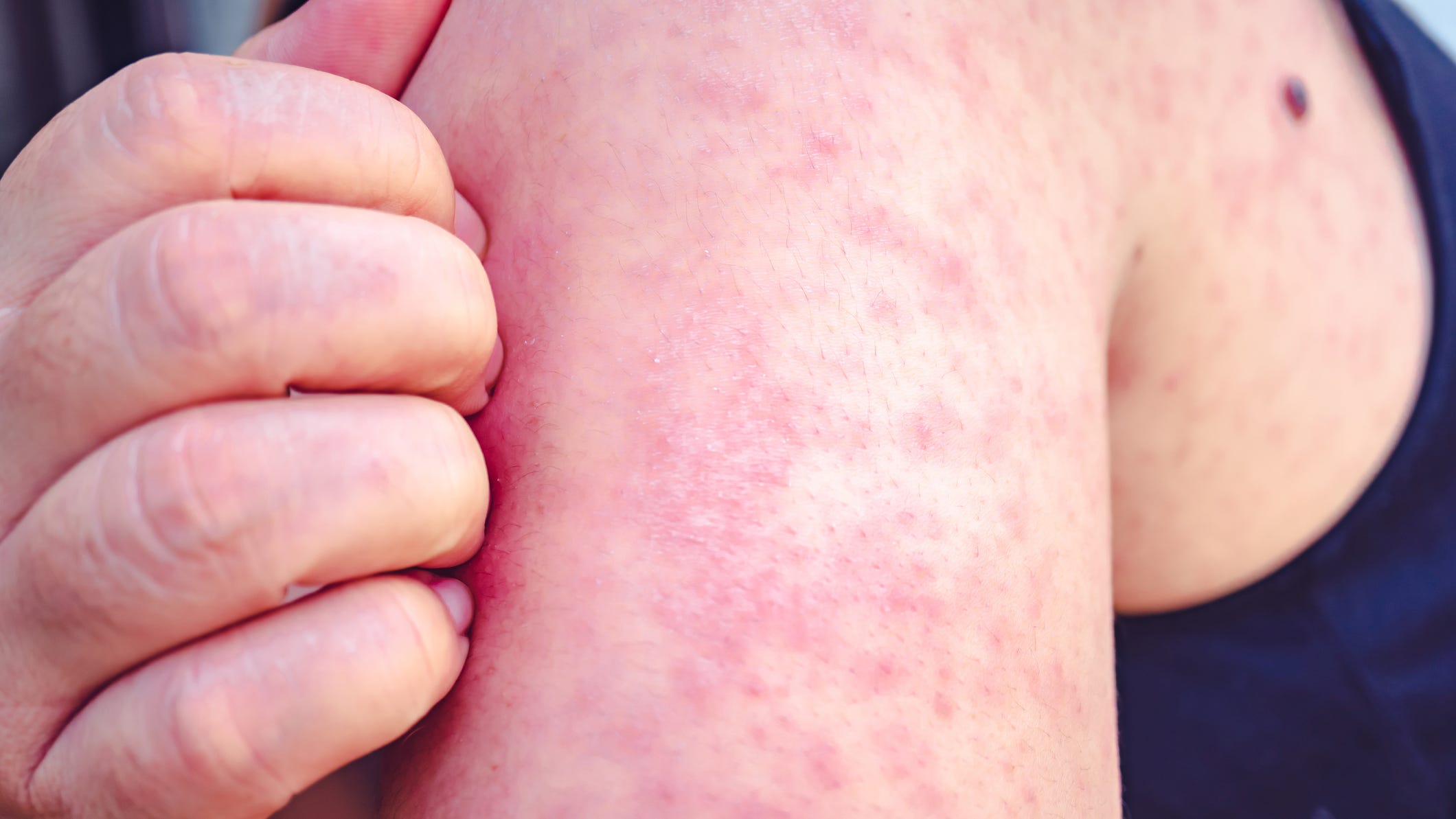 Ohio Reports Third Measles Outbreak in 2026 Amid Unvaccinated Cases and National Surge